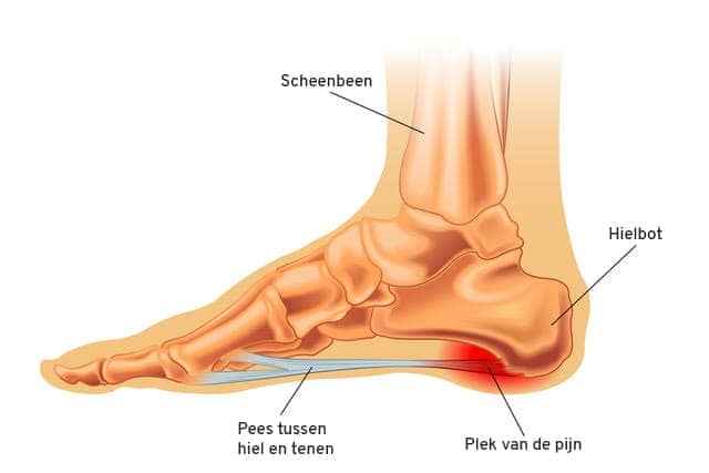 werkelijk Monetair Beknopt Hielspoor klachten? | Lees onze blog! - Klinkenberg Schoenen